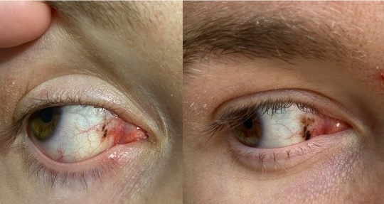photo of the cancer in matthew's eye